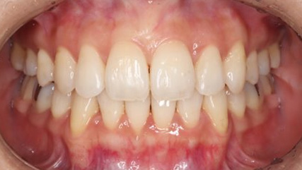 叢生、抜歯矯正治療、側貌改善AFTER3
