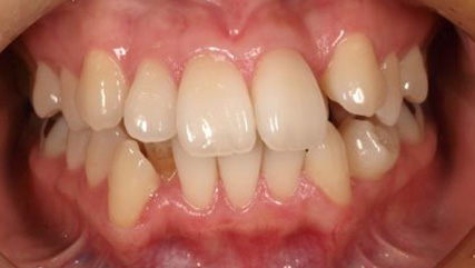 叢生、抜歯矯正治療、側貌改善BEFORE3