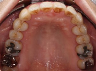 歯周病治療後の矯正治療AFTER1