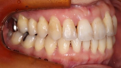 歯周病治療後の矯正治療AFTER2