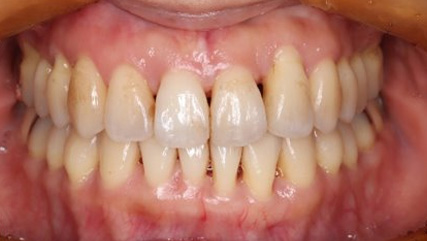 歯周病治療後の矯正治療AFTER3