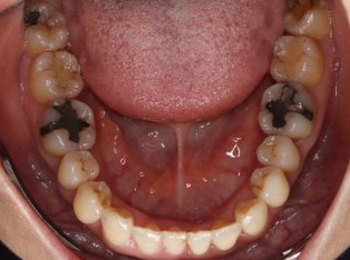 歯周病治療後の矯正治療AFTER5