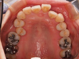 歯周病治療後の矯正治療BEFORE1