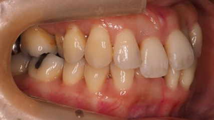 歯周病治療後の矯正治療BEFORE2