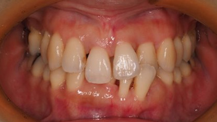歯周病治療後の矯正治療BEFORE3