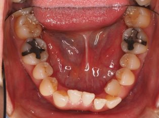 歯周病治療後の矯正治療BEFORE5