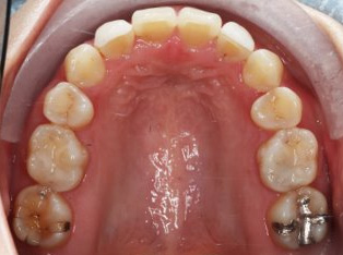 出っ歯、側貌改善、ガミースマイル治療AFTER1