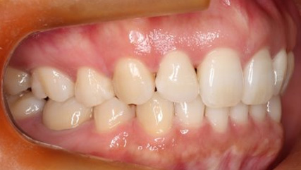 出っ歯、側貌改善、ガミースマイル治療AFTER2