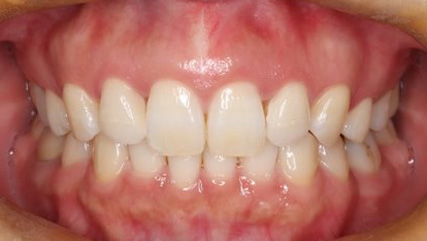 出っ歯、側貌改善、ガミースマイル治療AFTER3
