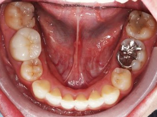 出っ歯、側貌改善、ガミースマイル治療AFTER5