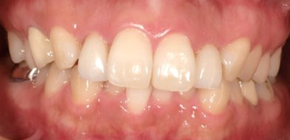 出っ歯、側貌改善、ガミースマイル治療BEFORE3