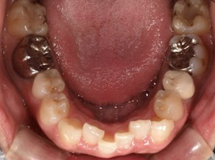 出っ歯、側貌改善、ガミースマイル治療BEFORE5